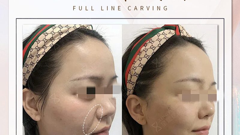 埋线提升：紧致肌肤，恢复青春