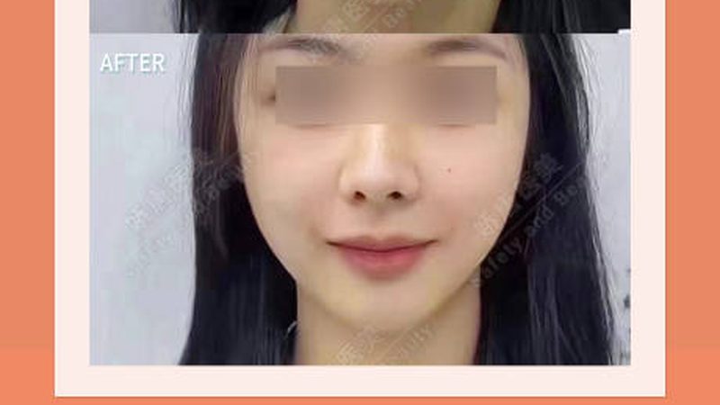 学生打瘦肩针肉毒素价格