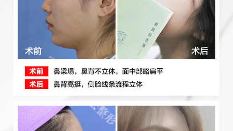 抗衰射频仪器怎么选厂家