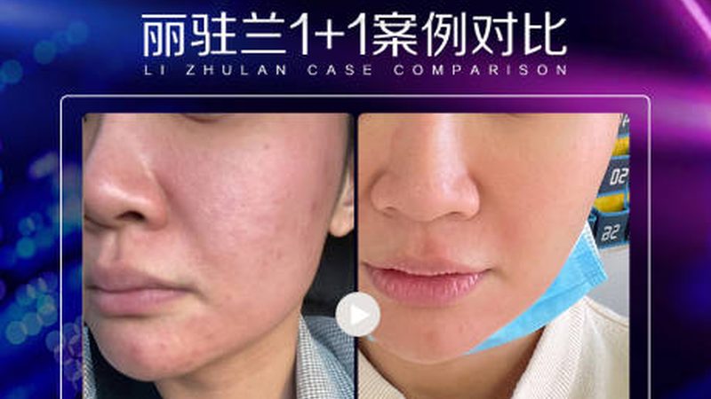 肉毒素面部提升：揭秘正规医院的价格构成