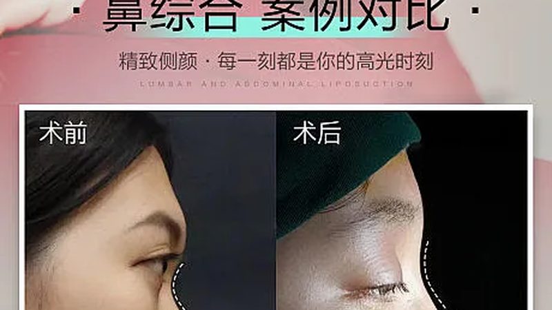 广州硅胶隆鼻十年后取出，医生如何选择？**