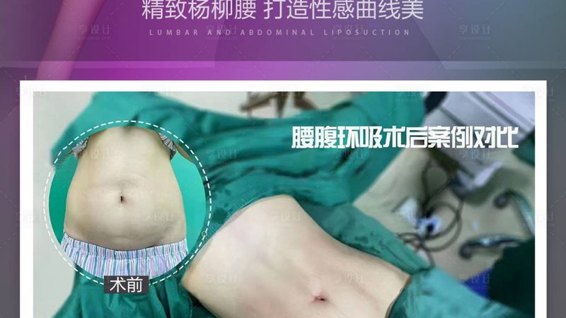 埋线提升术后运动恢复时间揭秘