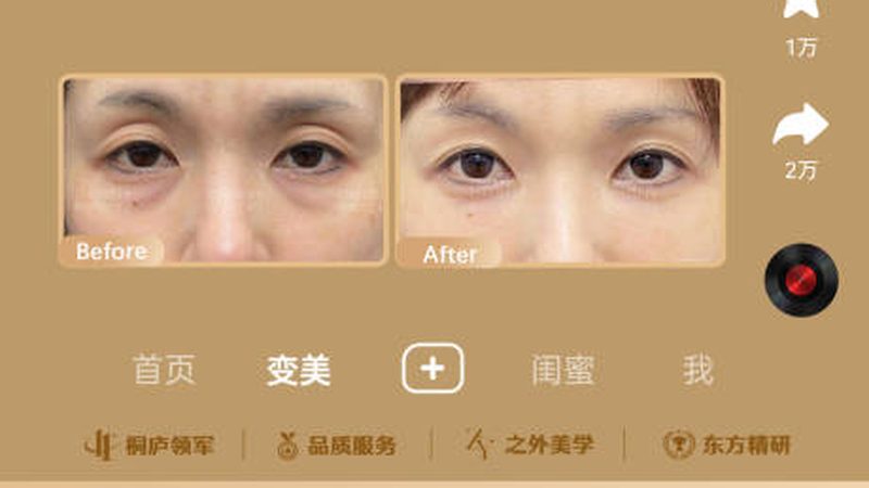 成都割双眼皮，揭秘适合哪些人群