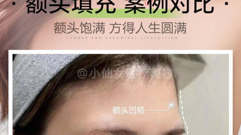 光子嫩肤仪功率参数揭秘：专业解析背后的技术秘密